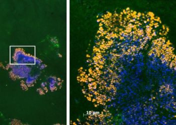 FISH Aufnahme eines Streptokokken-Biofilms auf einer menschlichen Herzklappe. Übersicht links: Der bakterielle Biofilm ist klar vor dem grünen Gewebshintergrund erkennbar.